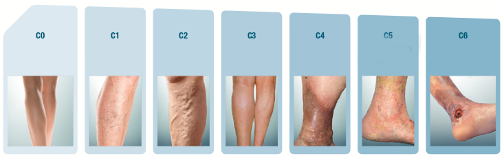 stages of varicose veins stages of varicose veins